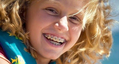 Có nên niềng răng cho trẻ em không?