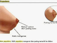 Tanaman Alami Untuk Mengobati Kanker Payudara