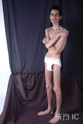Jeremy Gillitzer, anorexic, bulimic, anorexia, bulimia