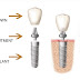 Chế độ dinh dưỡng sau khi trồng răng Implant