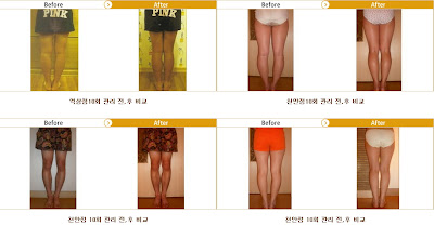 Curved Legs Care, Bowed Legs, Bow Legs