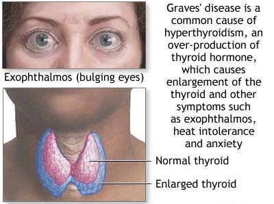 my eyes is the mirror of my heart: Thyroid Eye Disease