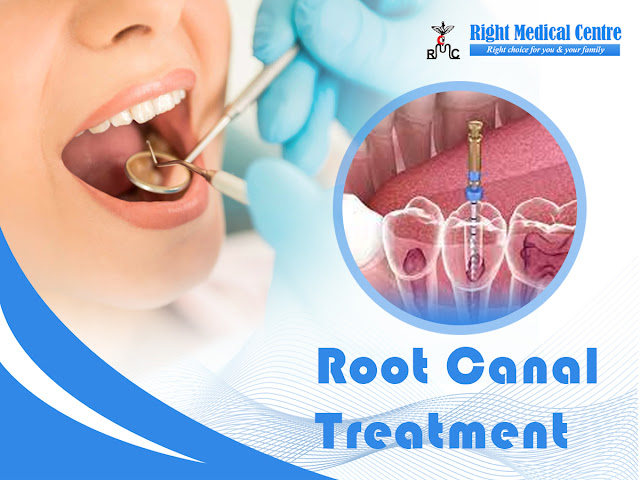 root canal treatment