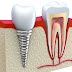 Cấy ghép implant có tốt không?