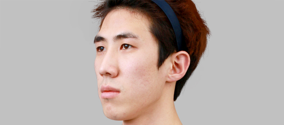 짱이뻐! - Korean Two Jaw Surgery Was The Right Solution For Him