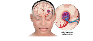 Arteriovenous Malformations: Challenges in Neurosurgical Treatment