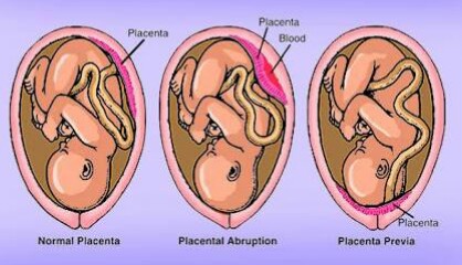 Beda Kehamilan Abruptio Plasenta dengan Plasenta Previa 