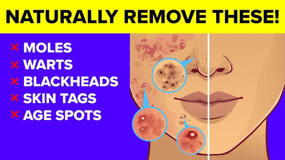 Tips on How To Naturally Cure Skin Tags, Moles, Warts, Blackheads, And Age Spots
