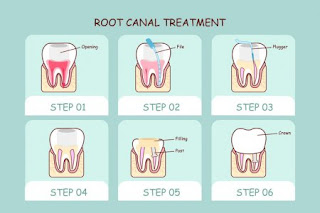 Rotary Endodontics Course, Endodontics Course India, Endodontic Courses in India, Endodontic Certificate Course