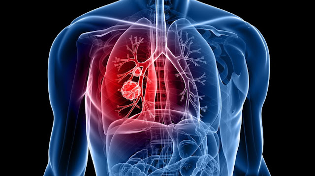Lung Cancer, lung cancer treatment