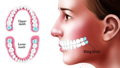 Răng khôn là răng hàm thứ 3 mọc sau cùng và trong cùng trên cung hàm