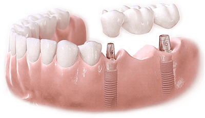 Cấy ghép răng implant như thế nào?