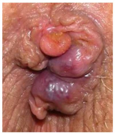 Inflammation anus