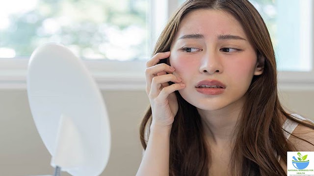 Natural Remedies for Eczema: Soothe and Heal Your Skin