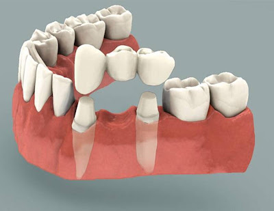 Quy trình làm cầu răng tại nha khoa uy tín