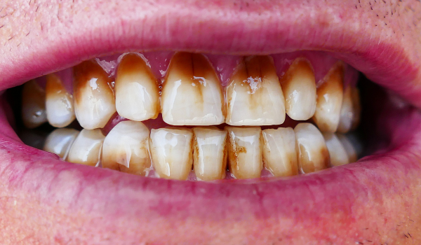HOW TO REMOVE COFFEE STAINS FROM TEETH