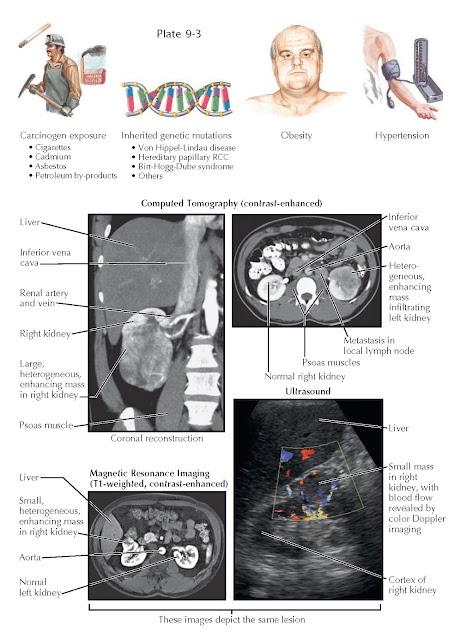 RISK FACTORS AND RADIOGRAPHIC FINDINGS OF RENAL CELL CARCINOMA