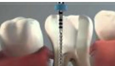 Para qué sirve la endodoncia