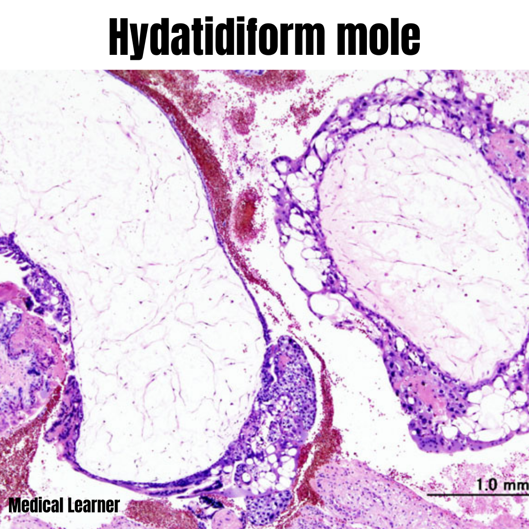 Hydatidiform mole