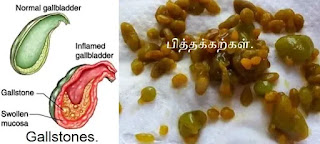 Gallstones