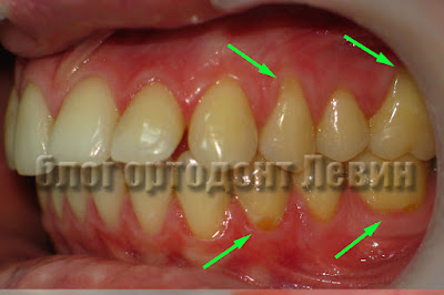 Рецессия десны осложнение ортодонтического лечения