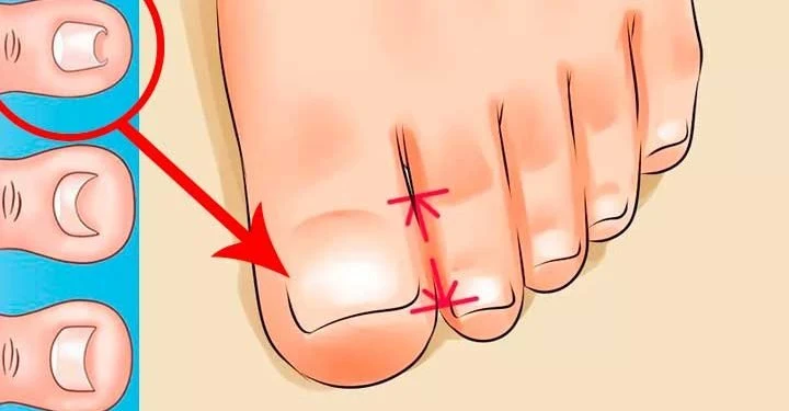 Treat Your Ingrown Toenail Easily And Naturally Without Going Through A Surgical Procedure