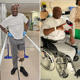 Nigerian man loses leg after home pedicure gone wrong