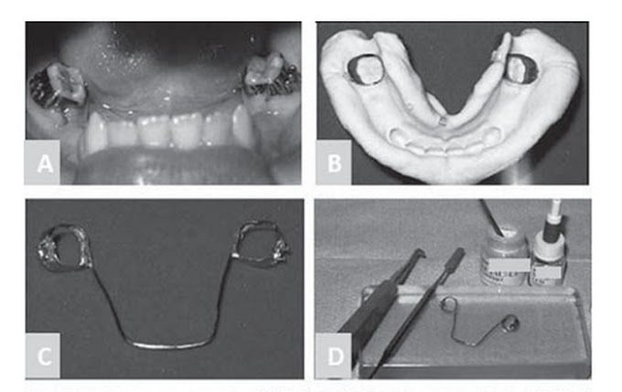 PDF: Arco lingual como mantenedor de espaço na perda precoce de dentes decíduos