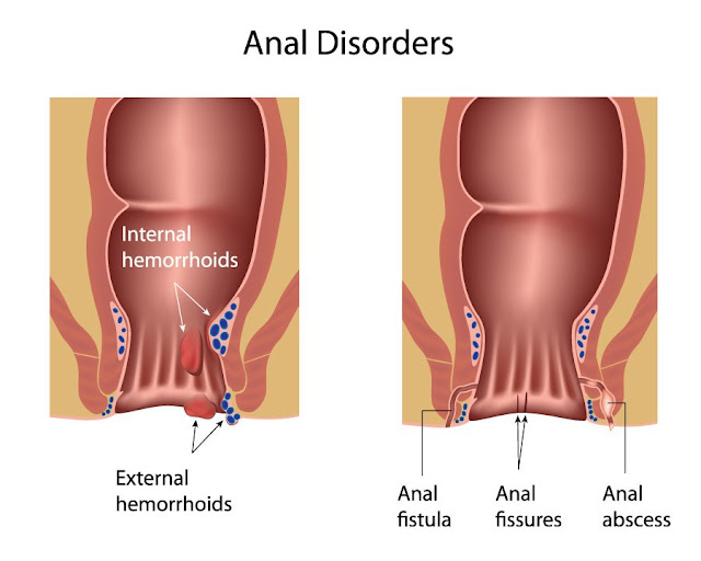 WHAT IS PILES? DIFFERENCE BETWEEN PILES AND HAEMORRHOIDS?  TYPES, HOW DO PILES START? CAUSES.SYMPTOMS TREATMENT