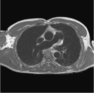 chest mri