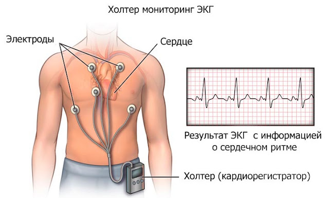 Обследование холтер: прибор, электроды, кардиограмма