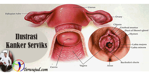 Kanker Serviks