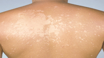 picture fungal infection tinea versicolor