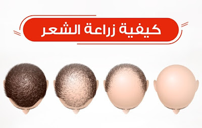 كيف تتم عملية زراعة الشعر الطبيعي واحدث التقنيات لذلك