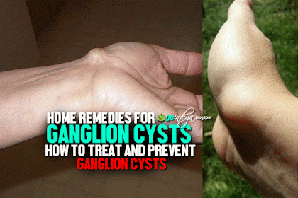 Home Remedies for Ganglion Cysts. How to Treat and Prevent Ganglion Cysts