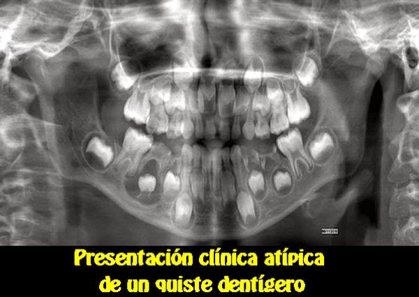 PDF: Presentación clínica atípica de un Quiste Dentígero