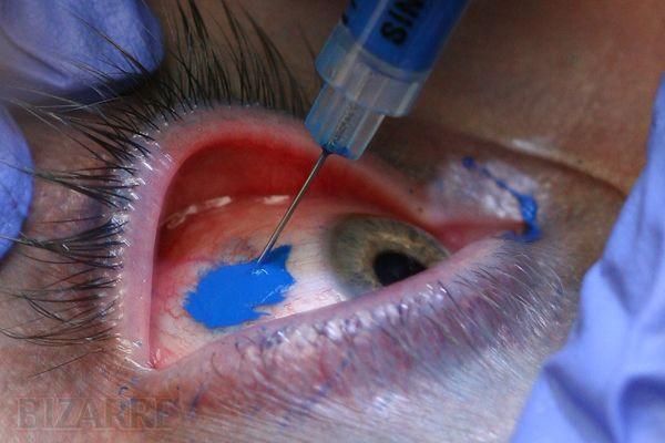 eye tattooing