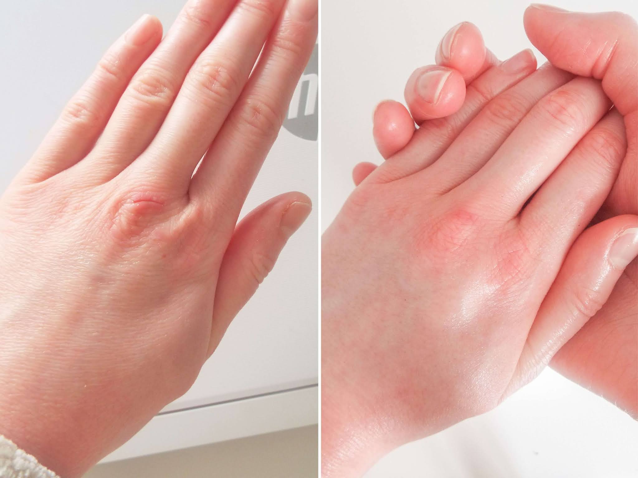 Comparison picture showing my dry, cracked, red hand on the left and healed hand, with soft supple, intact skin, to the right.