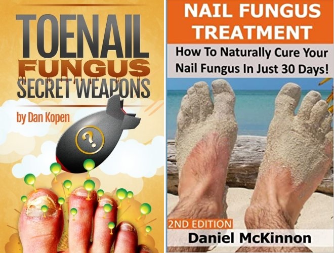 Knowledge Required for Treating Toenail Fungus at Home