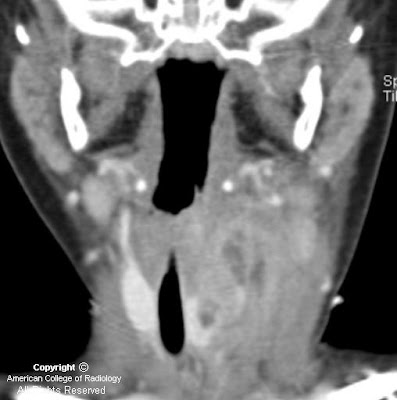 sinuses in head. pyriform sinus head and