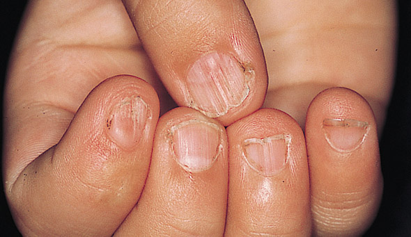 Vertical Ridges In Fingernails Vitamin Deficiency Awesome Nail