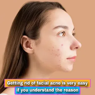 Permanent Relief from Acne