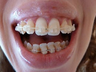 A photograph of teeth with fixed ceramic braces at week 17 of treatment