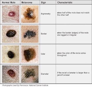 Skin Cancer Moles Types and Symptoms with Pictures