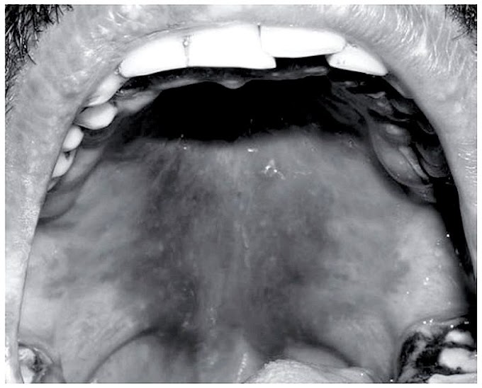 CLINICAL CASE: Acute Myeloid Leukemia - A case report with palatal and lingual gingival alterations