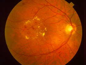 Figura 1. Edema Macular con presencia de los tres factores requeridos en el EMCS