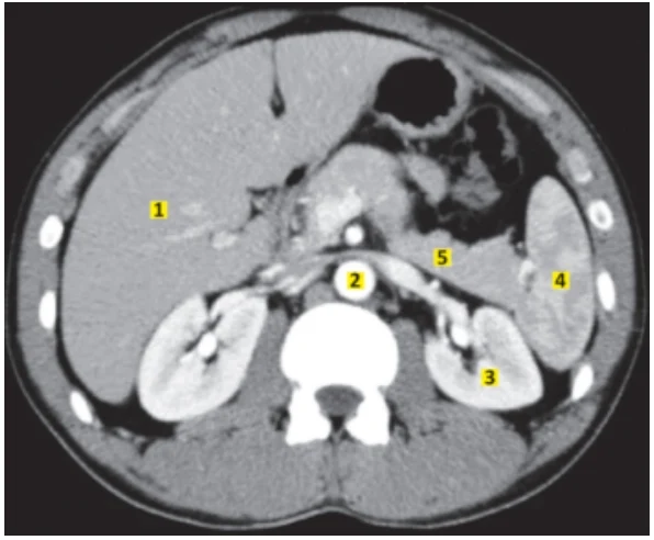 A figura a seguir apresenta uma tomografia do abdome superior com fase de contraste arterial.