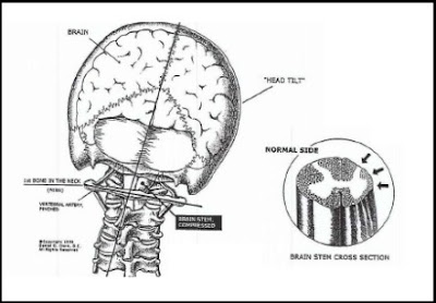   Un approccio bio-meccanico alla distonia cervicale