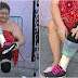 À espera de prótese, mulher com perna amputada improvisa com liquidificador