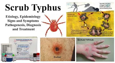 Image: Scrub Typhus